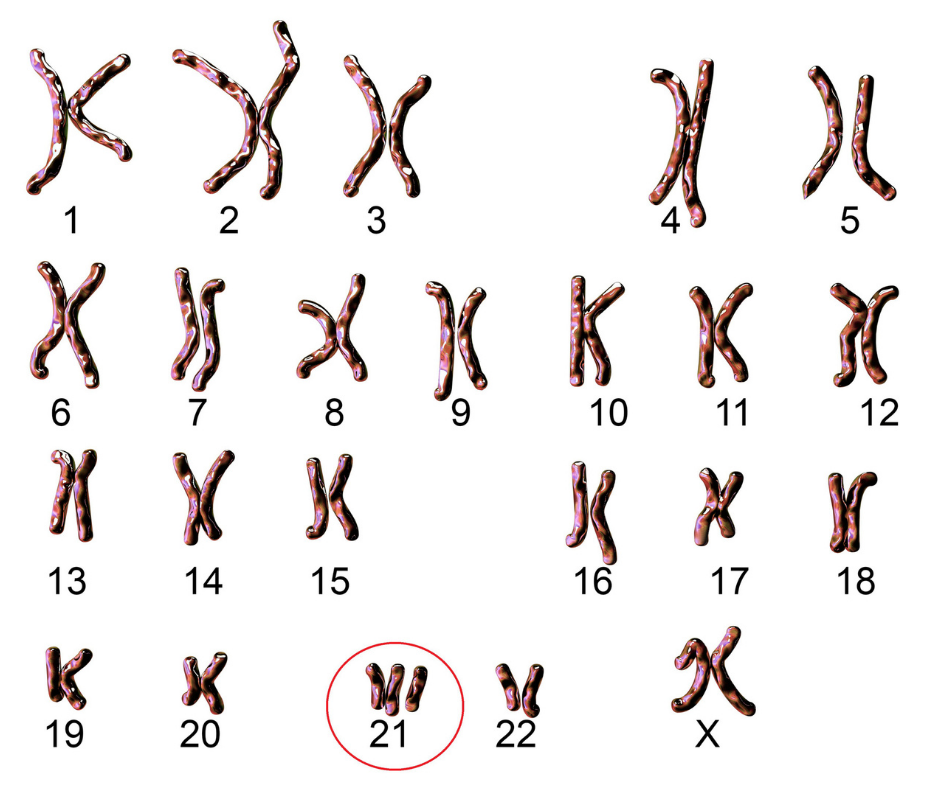 Trisomy 21 - Down Syndrome | Brighton Center